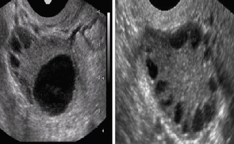 Polycystic Ovary Ultrasound