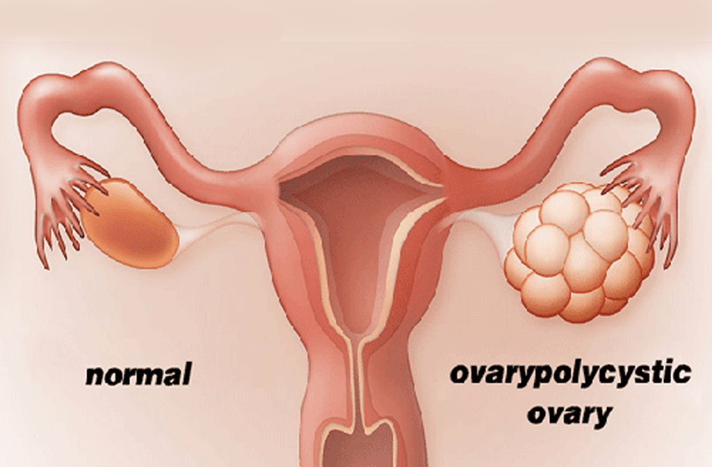 Polycystic-ovary