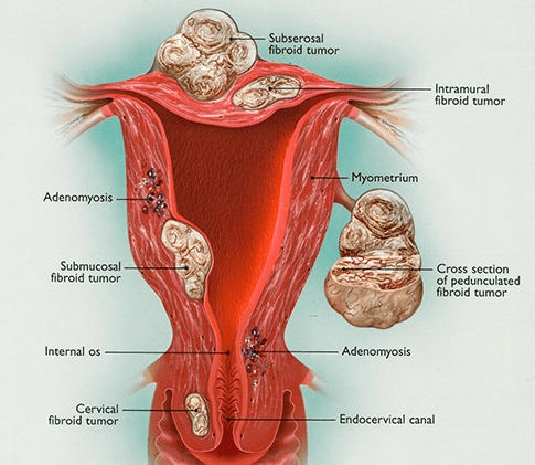 Cervical cancer complicating pelvic organ prolapse, and use of a
